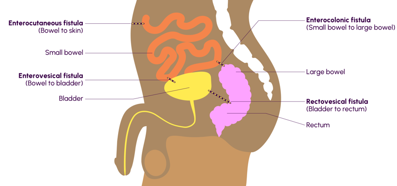Infographic showing types of fistulas - male