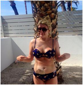 Image of Charlotte Guinea in a bikini with a colostomy bag