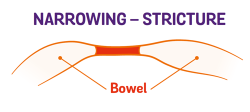 diagram showing narrowing of the bowel creating a stricture