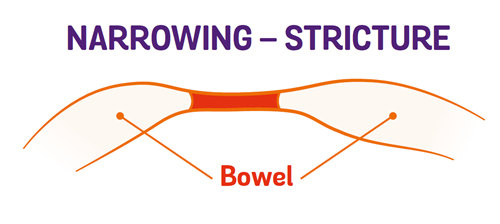 diagram showing narrowing of the bowel creating a stricture