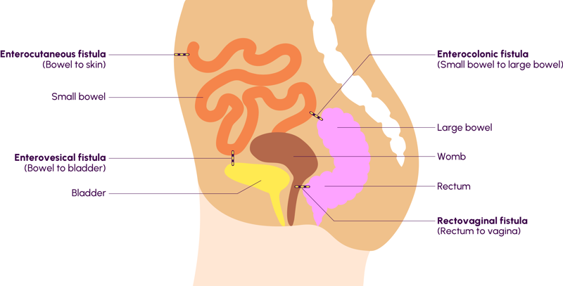 Infographic showing types of Fistulas - female