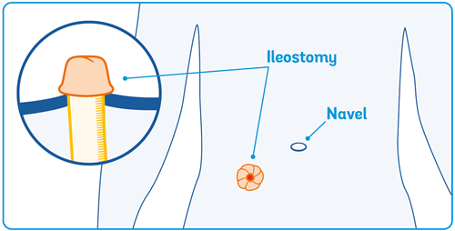 diagram showing where the stoma opening is located in a ilestomy