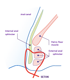 A diagram of a seton for an anal fistula